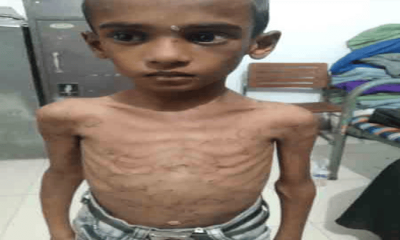 শিশু সোয়াইবের শরীর জুড়ে সিগারেটের ছ্যাকা, করানো হত ভিক্ষা