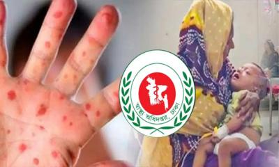 হামের উপসর্গে আরও ৫ শিশুর মৃত্যু, হাসপাতালে ১,২৮৩