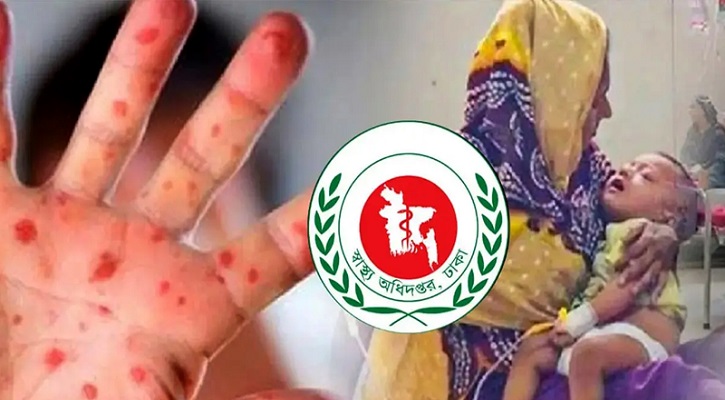 হামের উপসর্গে আরও ৭ শিশুর মৃত্যু, মৃতের সংখ্যা বেড়ে ৬৭৭