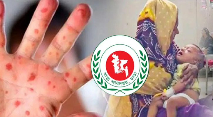 হামের উপসর্গে আরও ৫ শিশুর মৃত্যু, হাসপাতালে ১,২৮৩